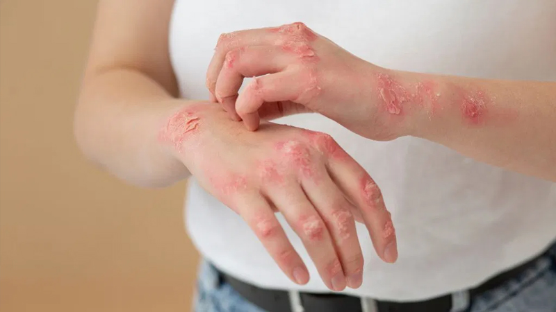 Psoriasis – Gejala dan Pencegahan dari PAFI Semarang